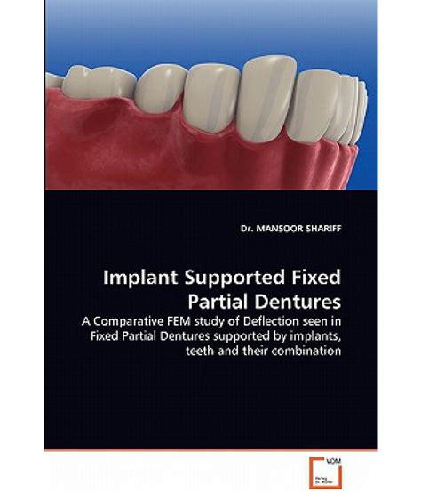 Implant Supported Fixed Partial Dentures: Buy Implant Supported Fixed ...