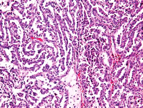 Renal Cell Carcinoma Histology