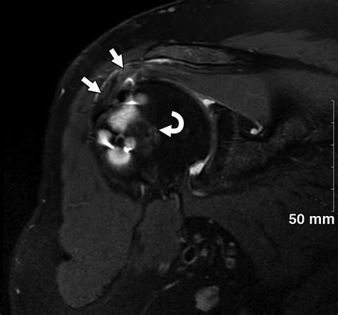 Multimodality Imaging Review Of Normal Appearance And Complications Of The Postoperative Rotator