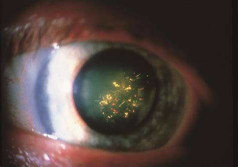 Myotonic dystrophy - American Academy of Ophthalmology