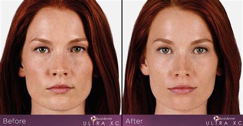 Juvederm Ultra Ultra Plus XC Treatments Smooth Synergy Medical Spa