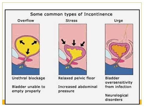 Woman Health Incontinenceandpelvic Organ Prolapse