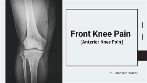 Front Knee Pain (Anterior Knee Pain) Treatment | Pain On Top Of Kneecap