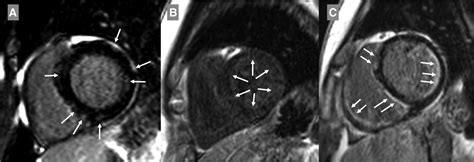 Cardiac Involvement In Systemic Sclerosis Diagnostic Tools Cardiology In Review