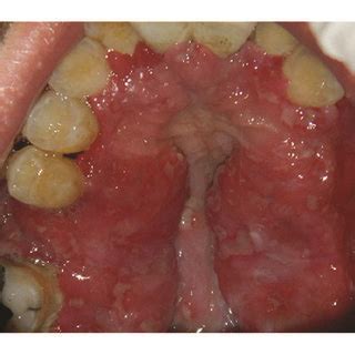 A Intraoral View Of The Patient After Extraction Of Teeth With Severe