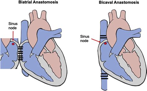 Cardiac Implantable Electronic Devices Following Heart Transplantation