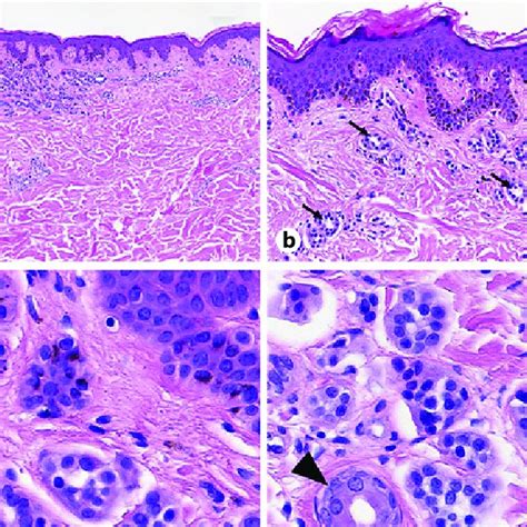 Intradermal Proliferation Of Epithelioid Cells A ×10 Forming Download Scientific Diagram