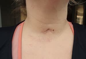 Tracheostomy Scar