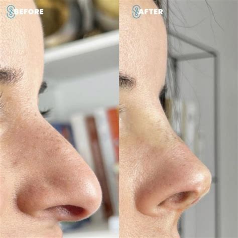 Non Surgical Rhinoplasty London Sas Aesthetics