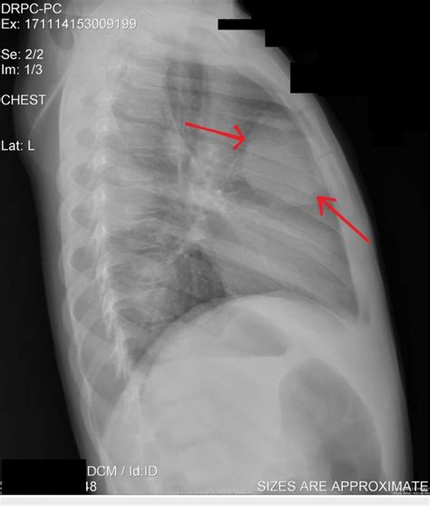 Lateral Cxr Anatomy