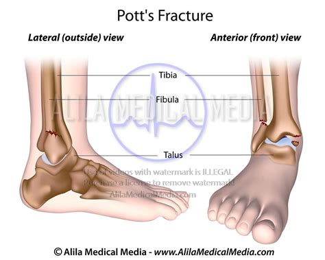 Alila Medical Media Pott S Fracture Labeled Medical Illustration