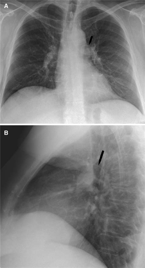 A A Posterior Anterior Chest Radiograph Demonstrating A Small