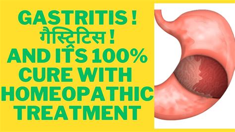 GASTRITIS BEST HOMEOPATHy MEDICINE FOR GASTRITIS YouTube