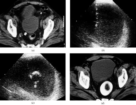 Ultrasound Guided Endocavitary Drainage Of Pelvic Abscesses Technique