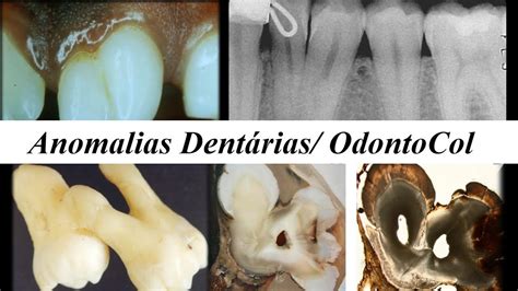 Anomalias Dent Rias Patologia Bucal Youtube