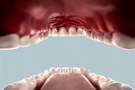 Bultos En El Paladar ¿a Qué Pueden Deberse Clínica Dental Tiiz