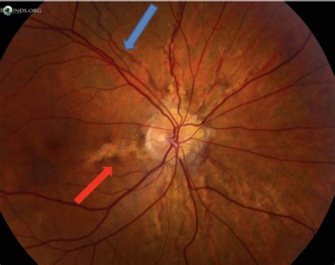 Other Macular Disorders Flashcards Quizlet