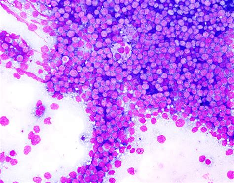 Pathology Outlines Burkitt Lymphoma