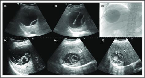 Pair A 26 Year Old Male Patient With Ce 1 Type Hydatid Cyst In Us Download Scientific Diagram