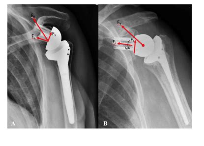 Radiographic Features Of Lateralized Reverse Shoulder Arthroplasty In