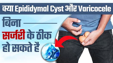 क्या Epididymal Cyst और Varicocele बिना सर्जरी के ठीक हो सकते है