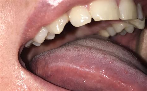 Swollen Lymph Nodes Hiv Symptoms