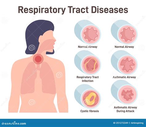 Trachea Narrowing Awareness Icon Of Tracheal Stenosis Vector