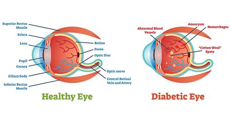 What Is Diabetic Retinopathy Montgomery Eye Physicians