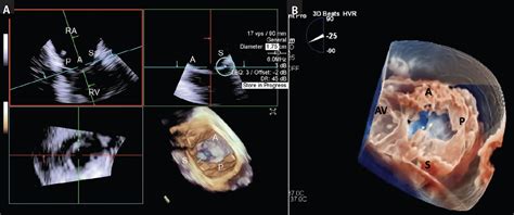 Three Dimensional Intracardiac Echocardiography Use In Tricuspid Valve