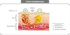 Iontophoresis is a method of delivering medication through the skin by using a gentle electrical ...