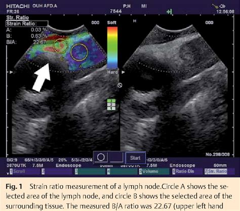 Figure 1 From Intra And Interobserver Agreement Of Endoscopic