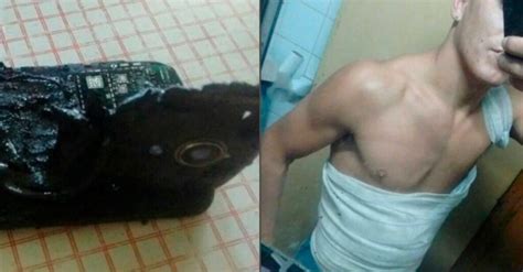 Joven Sufre Quemaduras Tras Explotarle Su Celular En El Pecho