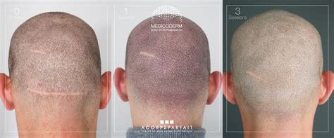 Solution La Calvitie Par Micropigmentation Capillaire Namur