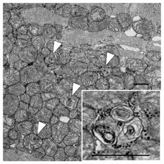 Electron Microscopic Investigation Of Endomyocardial Biopsy Electron