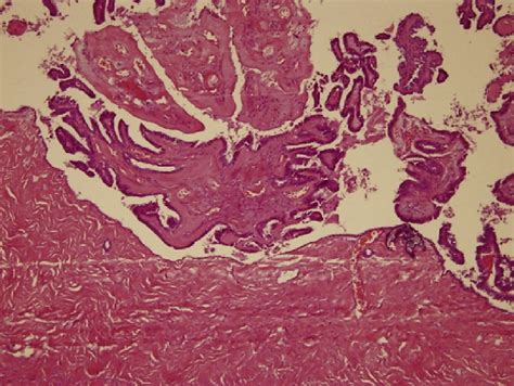 Histopathology Using Hematoxylin And Eosin Staining Confirmed A Serous