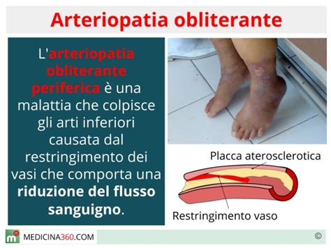 Arteriopatia Obliterante Cos Sintomi Stadi Cause E Terapia