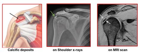 Shoulder Calcific Tendinitis Home Consultant Orthopaedic Surgeon