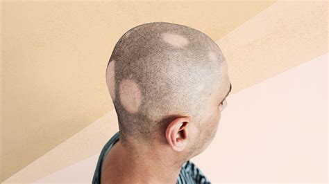 Alopecia Areata Haircut Male Parmjeettiaami