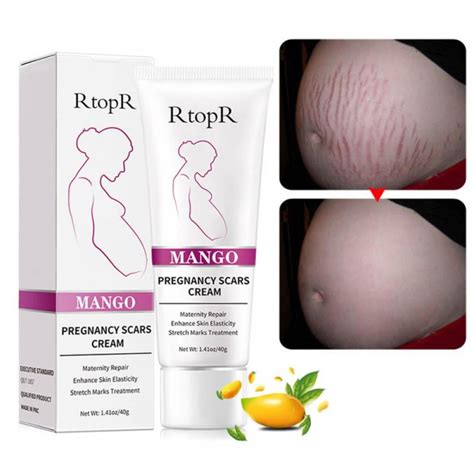 Mango Stretch Marks And Scar Cream Stretch Marks And Scar Removal