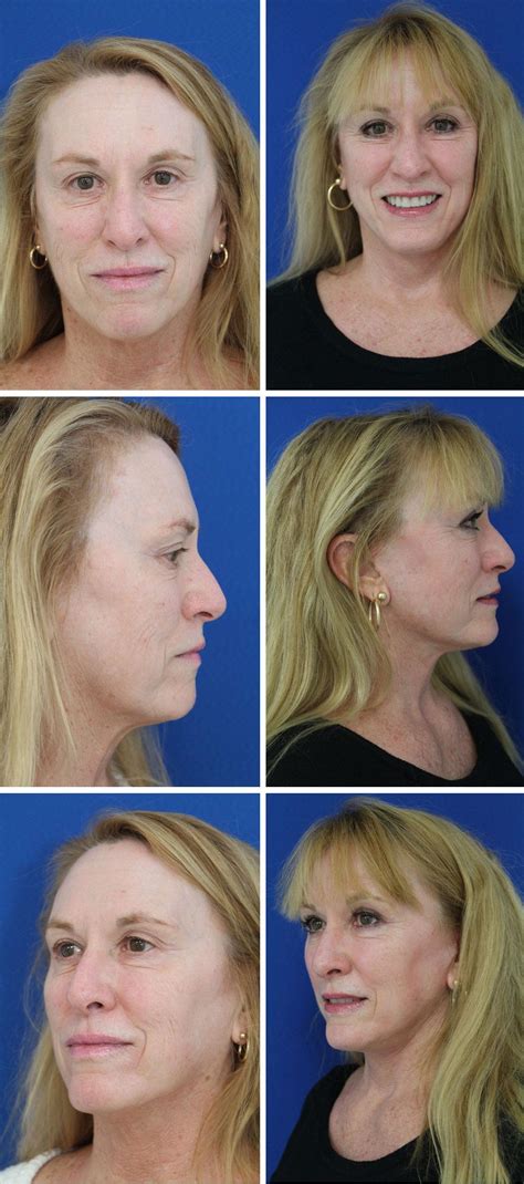 Fraxel Laser Skin Resurfacing Dc Area Arlington Va Advanced Plastic