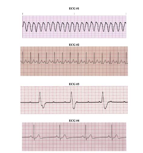 Solved Normal Sinus Rhythm Nsr Identify The Ecgs With