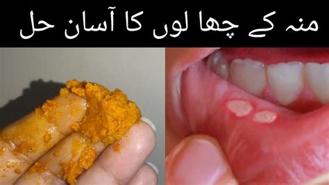 Mun K Chalon Ka Ilaj How To Get Rid Of Mouth Ulcers Fast At Home Munh K