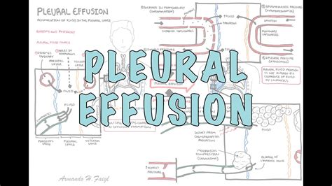 Pleural Effusion Stages