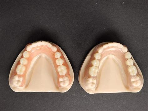 Partials Valplast Products Products An Outsourcing Dental Lab