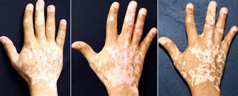 Vitiligo Treatment Holds Promise For Restoring Skin Pigmentation