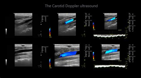 A Carotid Artery Doppler Ultrasound Is A Diagnostic Test Used To Check The Arteries In The Neck