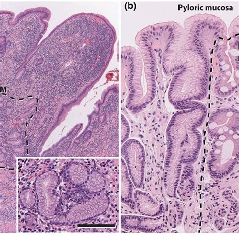 Pyloric Gland Metaplasia Is A Marker Of Chronic Injury In The