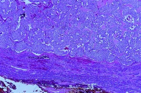 Low power view showing the pushing margin of the islet cell component ...