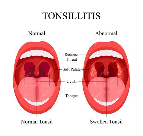 Premium Vector Diagram Of Tonsillitis Causes Normal Tonsils And