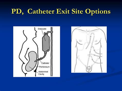 Ppt Pd Catheter Exit Site Options Powerpoint Presentation Free